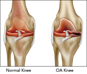 lasersko liječenje zgloba koljena s artrozom
