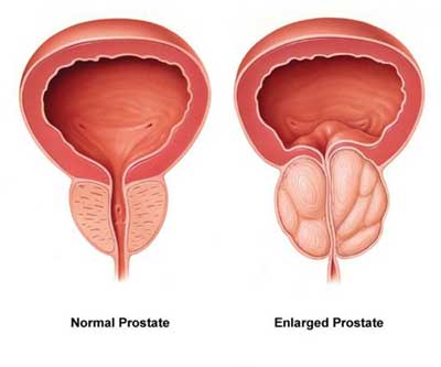 Kista Prostate Hyperplasia a prosztata adenoma konzervatív kezelése