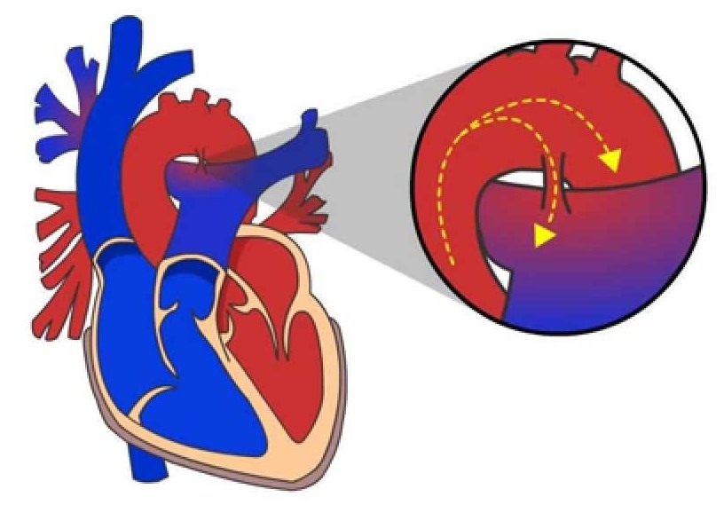 Открытый аортальный проток схема