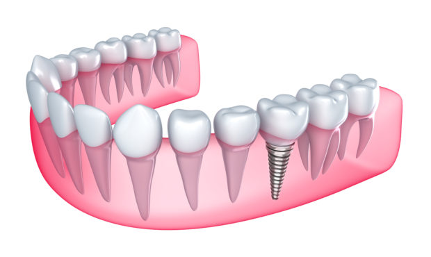 Имплантация нескольких зубов